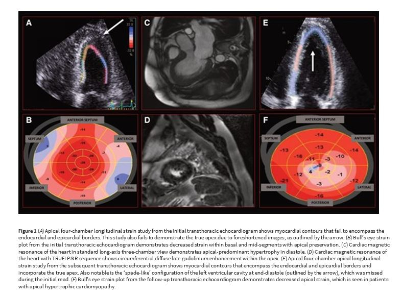 European Society of Cardiology Journals (@esc_journals) on Twitter photo A strain on the diagnosis academic.oup.com/ehjcr/article/…
#EHJCaseReports #echofirst <a href="/KardiologieHH/">Erik Rafflenbeul</a> <a href="/aayshacader/">Aaysha Cader</a> <a href="/TJ_Yeo/">Tee Joo YEO</a> <a href="/ANazmiCalik/">A.Nazmi Calik</a> <a href="/FarhanaAra/">Farhana</a> <a href="/cfcamm/">Fielder Camm</a> <a href="/EHJCREiC/">EHJCaseReports Editor-in-Chief</a> A strain on the diagnosis academic.oup.com/ehjcr/article/…
#EHJCaseReports #echofirst <a href="/KardiologieHH/">Erik Rafflenbeul</a> <a href="/aayshacader/">Aaysha Cader</a> <a href="/TJ_Yeo/">Tee Joo YEO</a> <a href="/ANazmiCalik/">A.Nazmi Calik</a> <a href="/FarhanaAra/">Farhana</a> <a href="/cfcamm/">Fielder Camm</a> <a href="/EHJCREiC/">EHJCaseReports Editor-in-Chief</a>