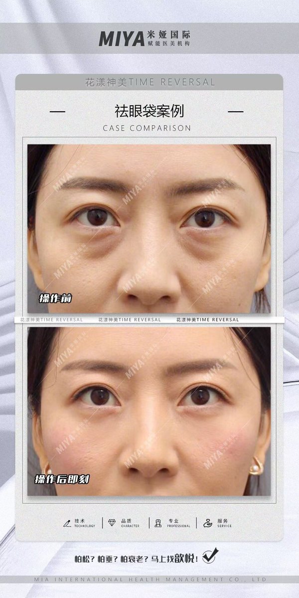 TransgenderHome's tweet photo. 花漾神美｜祛眼袋案例

无痕祛眼袋案例对比 无惧年龄 随时显露年轻态 这就是我的潇洒牌 https://t.co/W5DdQklEAw