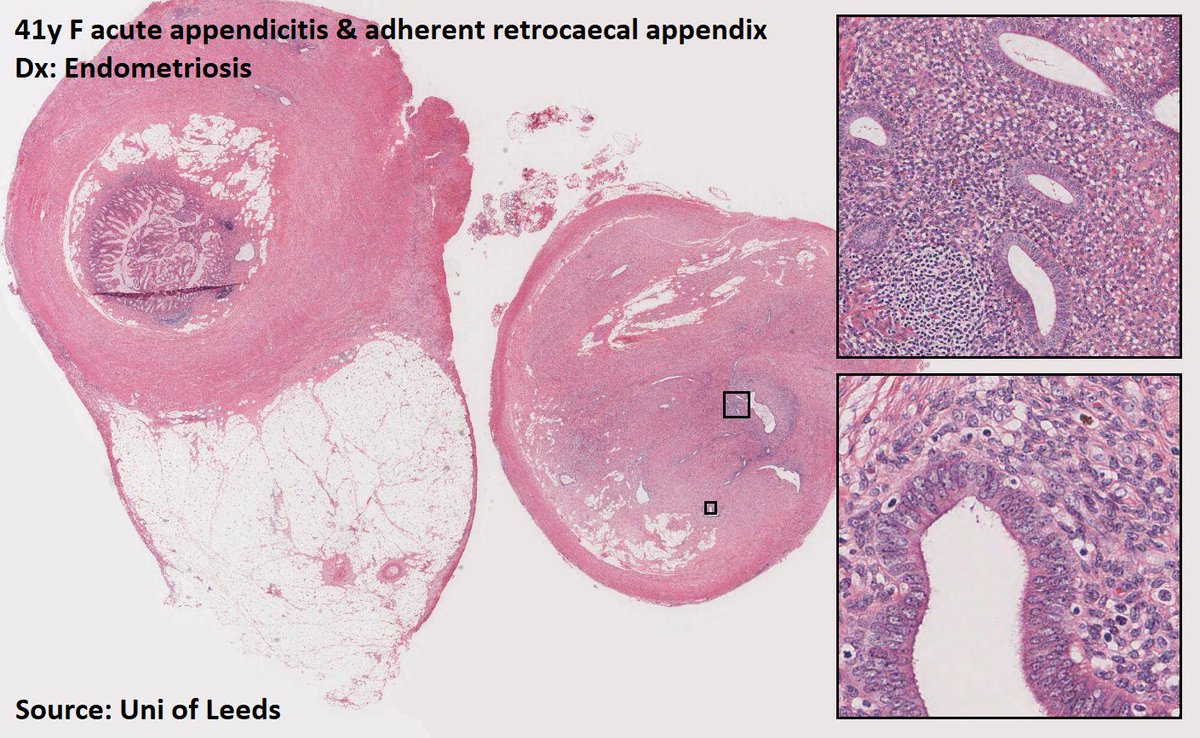 DrTravisBrown's tweet photo. Histology flash card
Endometriosis
Ectopic endometrial tissue
~10% reprod age ♀
⬆️ with FHx, nulliparity, early menarchy (<11-13yr), late menopause
⬇️ with multiple births, extended lactation, late menarchy (>14yr)
Assoc with fertility issues
Ep 19 #ThisPathLife #podcast https://t.co/iQLztnNs79
