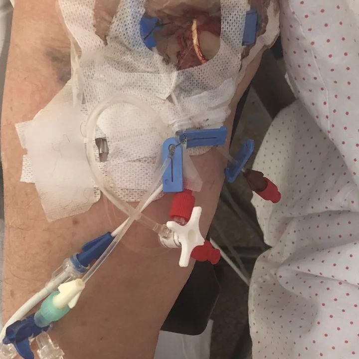 Mil y un fallo...detectáis todos?.....seguimos sin ver la importancia de los accesos vasculares.😔