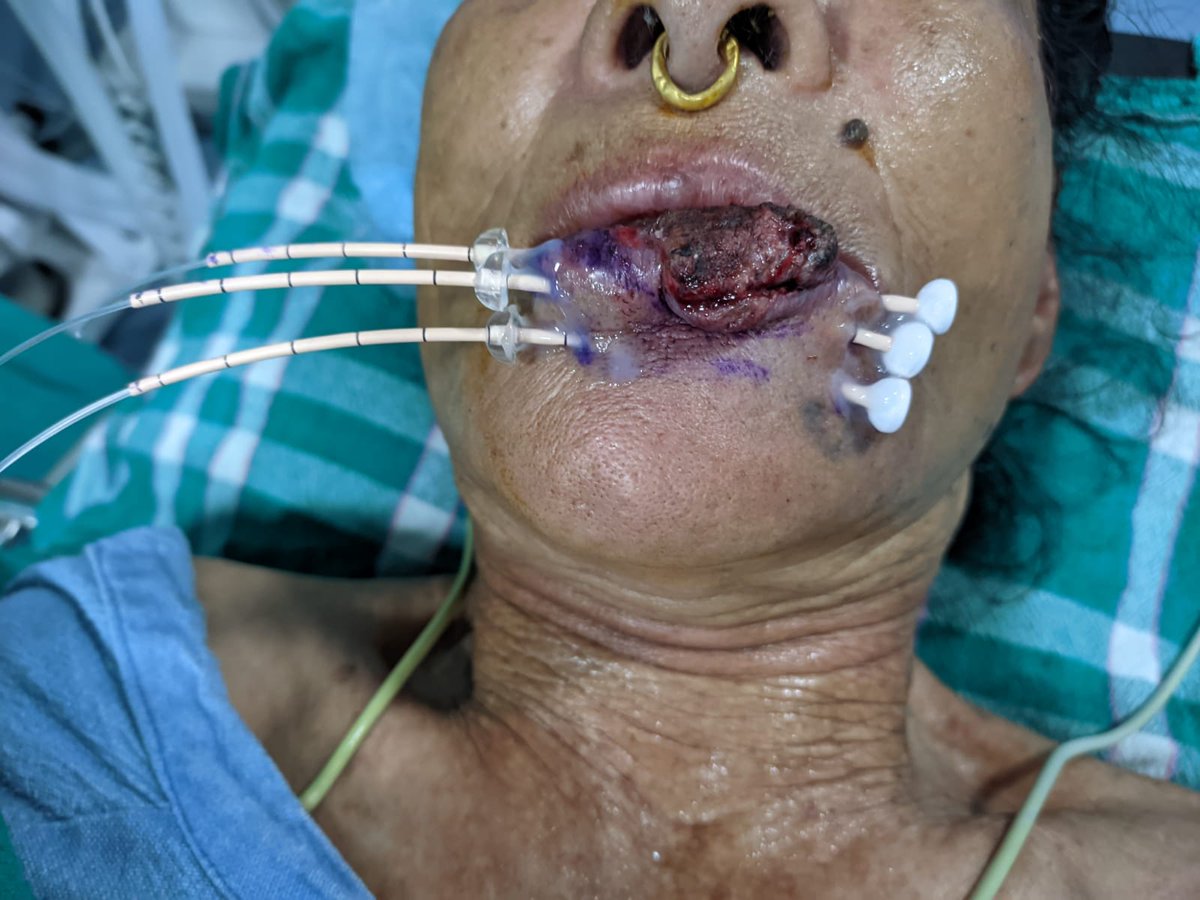 SimitSapkota's tweet photo. Another day, another carcinoma lip, another interstitial brachy. Loving life @KtmCancerCenter with @supKCC @JhaDeepakSuman. #Thisisbrachytherapy https://t.co/8xbNRwFUt7
