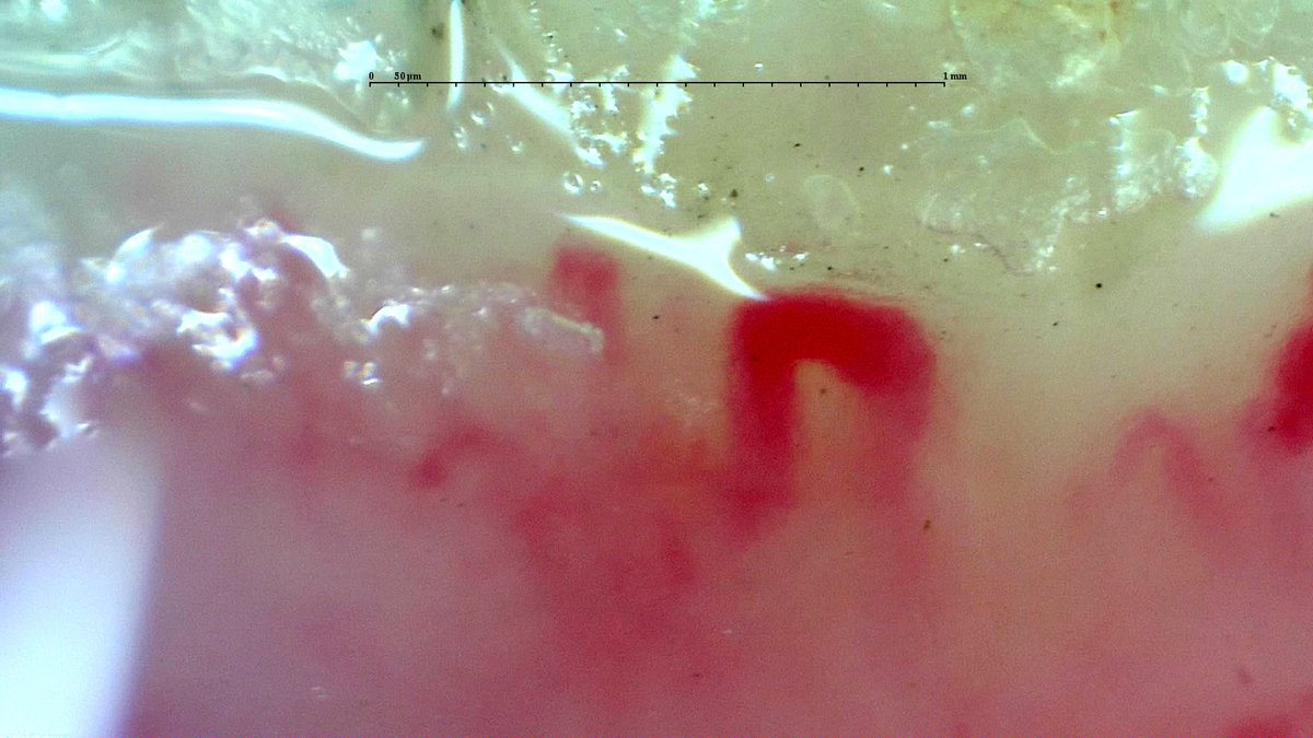gmaldonadovelez's tweet photo. Capillaroscopy of the day ๐ฌ
Raynaudโs phenomenon evaluation โ๐ฝ
๐ฆ Giant capillaries
โ Avascular areas
๐ชด Ramified capillaries
๐ Late SD-pattern
#Capillaroscopy #MedTwitter #RheumTwitter #CapillaryIo #Raynaud https://t.co/ASmyA9kuUu