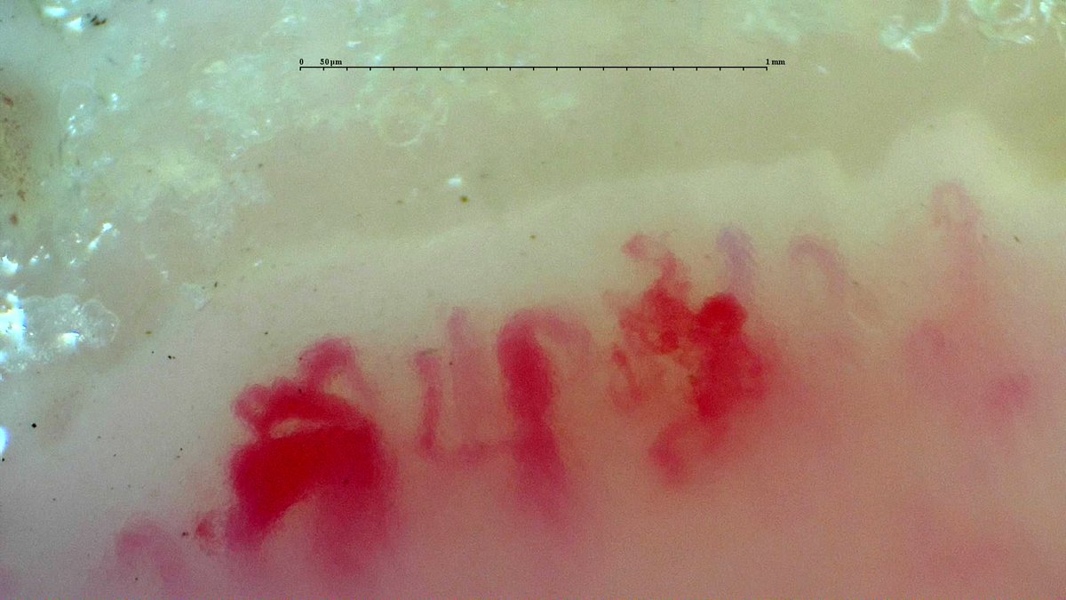 gmaldonadovelez's tweet photo. Capillaroscopy of the day ๐ฌ
Raynaudโs phenomenon evaluation โ๐ฝ
๐ฆ Giant capillaries
โ Avascular areas
๐ชด Ramified capillaries
๐ Late SD-pattern
#Capillaroscopy #MedTwitter #RheumTwitter #CapillaryIo #Raynaud https://t.co/ASmyA9kuUu