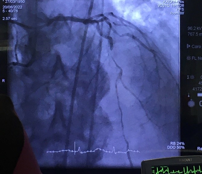 CARDIVAGROUP's tweet photo. Los Dres. @GomezHospital y M. Gracida, de @hbellvitge, tratan con #pVAD de #PulseCath a un paciente CHIP rechazado por cirugía. Proporciona estabilidad #hemodinámica en +2,5h de procedimiento y minutos tras ICP, con angiografía excelente. ¡Enhorabuena y gracias por la confianza! https://t.co/acf6BWDZ8t