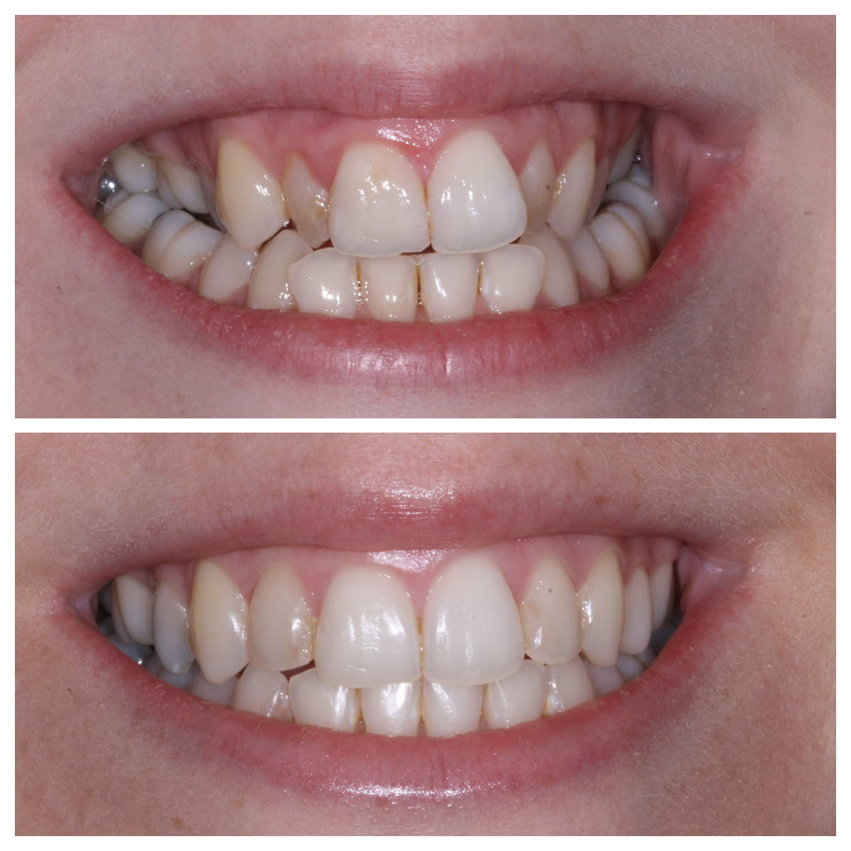 Deverondental's tweet photo. Invisalign @ Deveron Dental Centre 💫 It is a New Year so why not get a new smile? Invisalign is the invisible way to straighten your smile. #invisalign #invisalignuk #invisalignteen https://t.co/2wVK7X0YSM