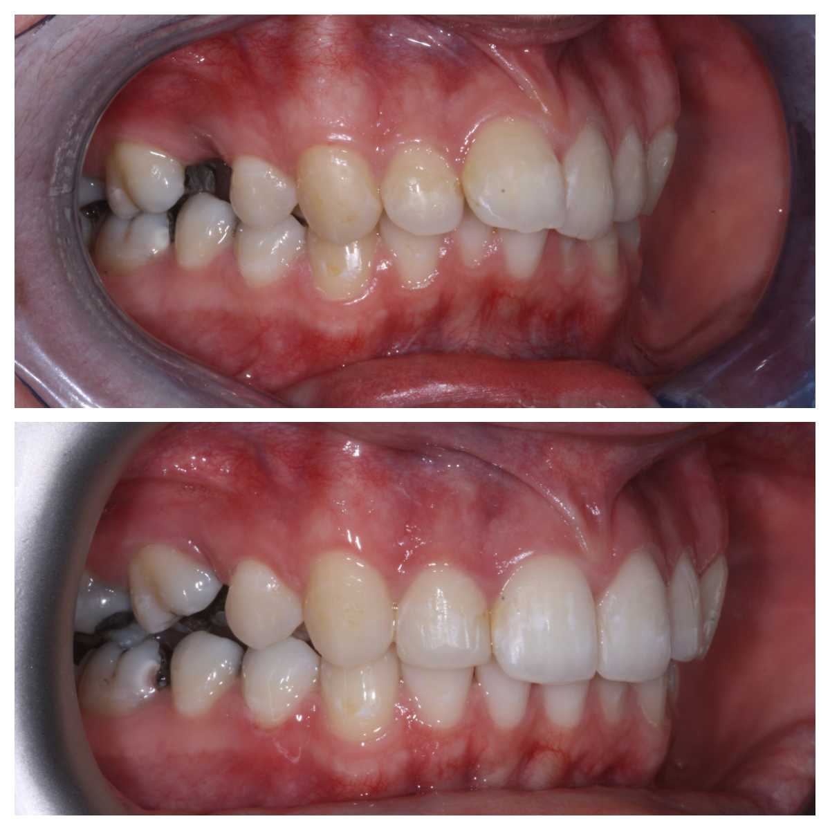 Deverondental's tweet photo. Here are some Invisalign before and after photos of one patients case completed at the practice by Morven. If you would like to straighten your smile call us on 01466 794089 🌟 You don't have to be registered with us to straighten your teeth with us! #invisalign #invisalignuk https://t.co/1qS6on3j8B