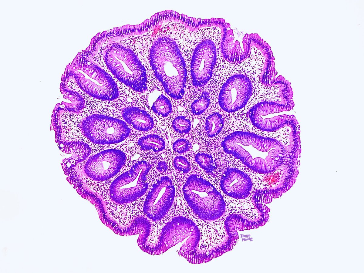DiegoMoralesN's tweet photo. Colonic polyp.
That's It. That's the Tweet.
#pathtwitter #gipath #TooPrettyNotToShare #JoyForMorphology #freudeandermorphologie https://t.co/zvlhfO58Tp