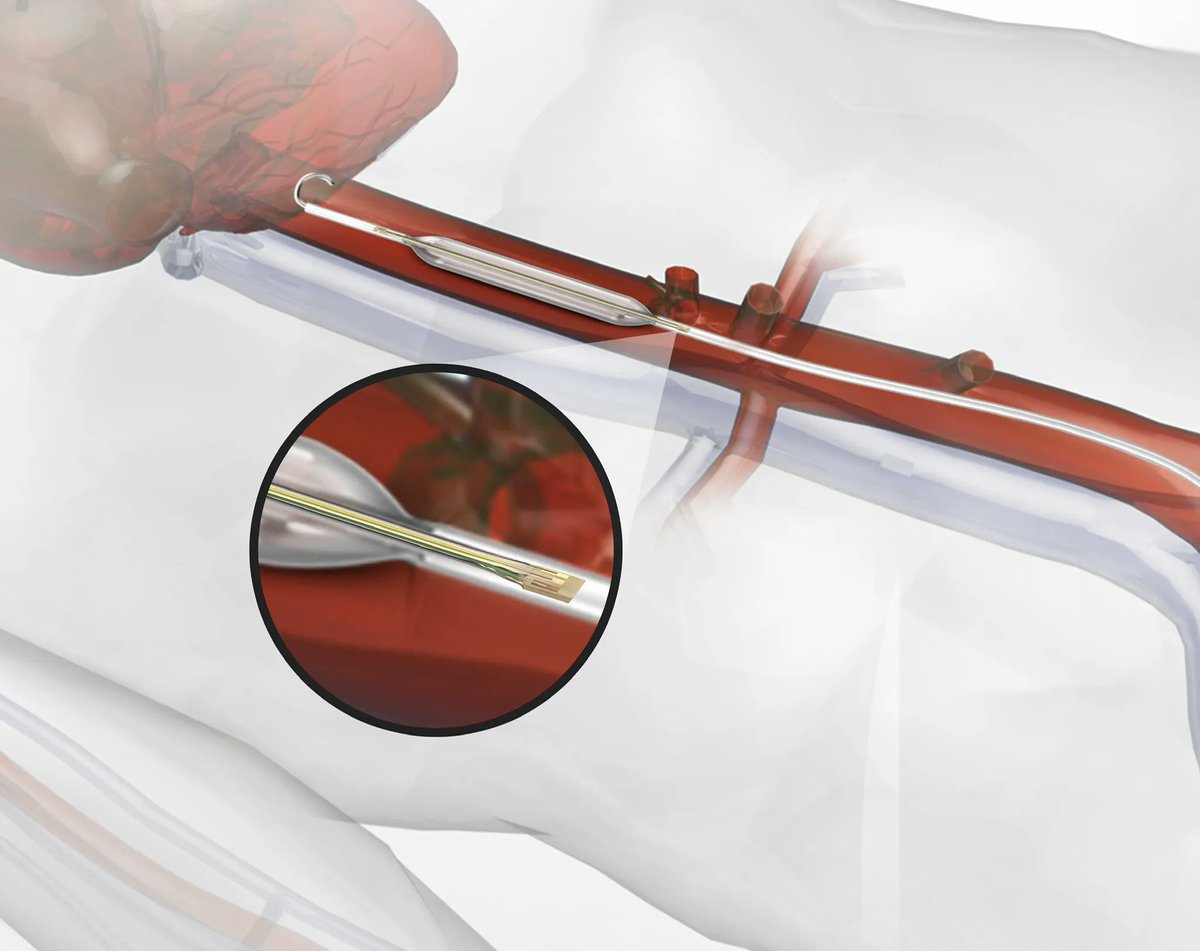 EVAC Fact No. 3️⃣ // The solid state sensors on either side of the balloon catheter measure absolute blood pressure and provide high-fidelity data to precisely adjust the balloon. Discover more 👉buff.ly/3stILLC #traumacare