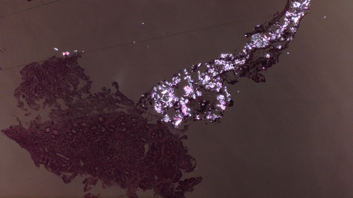 Erosive pill gastritis, polarizing pill fragments. #GIpath #PathTwitter #pathology #GIPS #pathologists #MedTwitter #endoscopy
