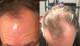 imediamarketplc's tweet photo. Clint at Two Months: “After only using this product for two months my friends started telling me that they noticed my hair getting thicker. I didn’t realize it was working until I looked at the before and after pictures." #vitaluxe #stophairloss #thickhair #imediamarketplace https://t.co/hccQeHI4rQ