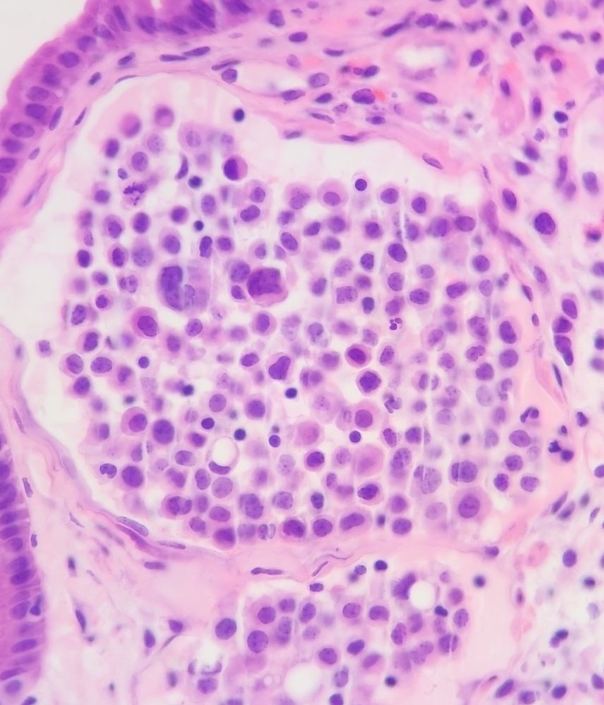 Duodenal stenosis.

Is this #GIpath or some other #pathology?

#PathTwitter