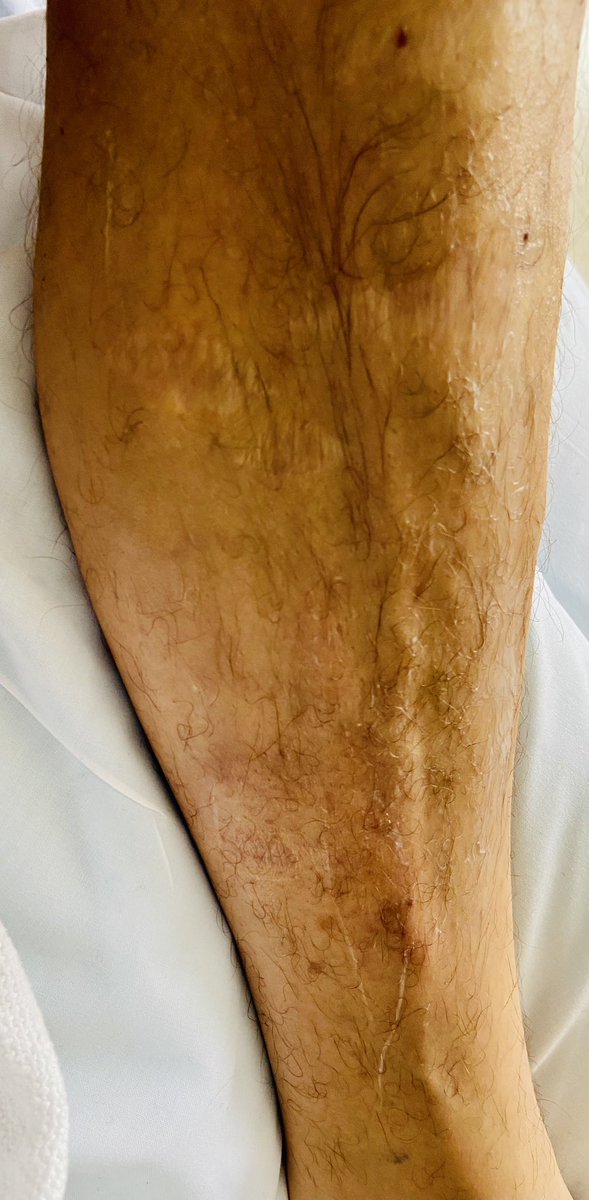 CainMonroe's tweet photo. Still struggling, can barely walk. Arm has much improved! 

I’ve learnt to photograph everything; which really saved me from a Dr that was so certain.  

Relaxing and resting; doing all I can to get the hell outta the hospital. https://t.co/9qJQHWI8Gw
