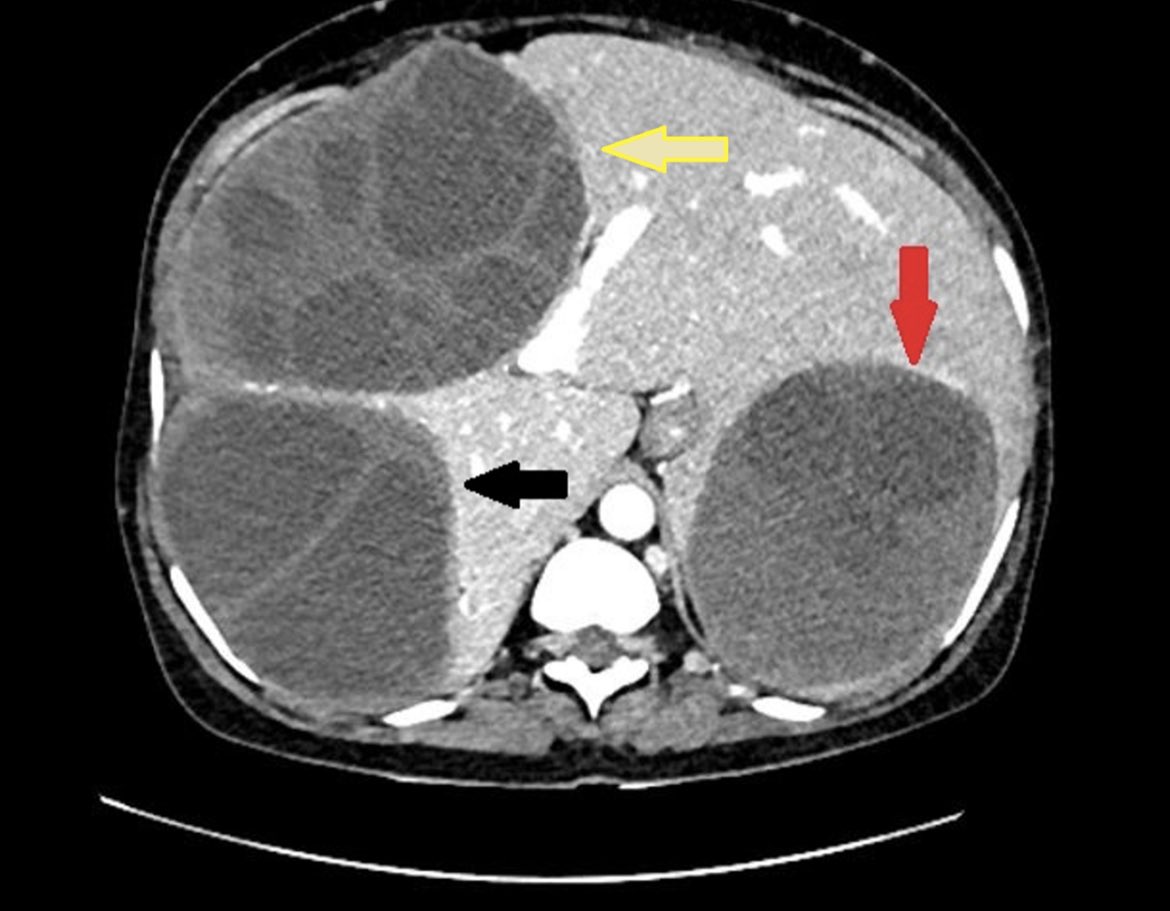 radRounds's tweet photo. What could these multiloculted cystic lesions represent? #radtwitter #MedTwitter #meded #futureradres #medicalstudents #usmle #MCAT #boardquestion #Match2023 https://t.co/lru4l9Hwxn