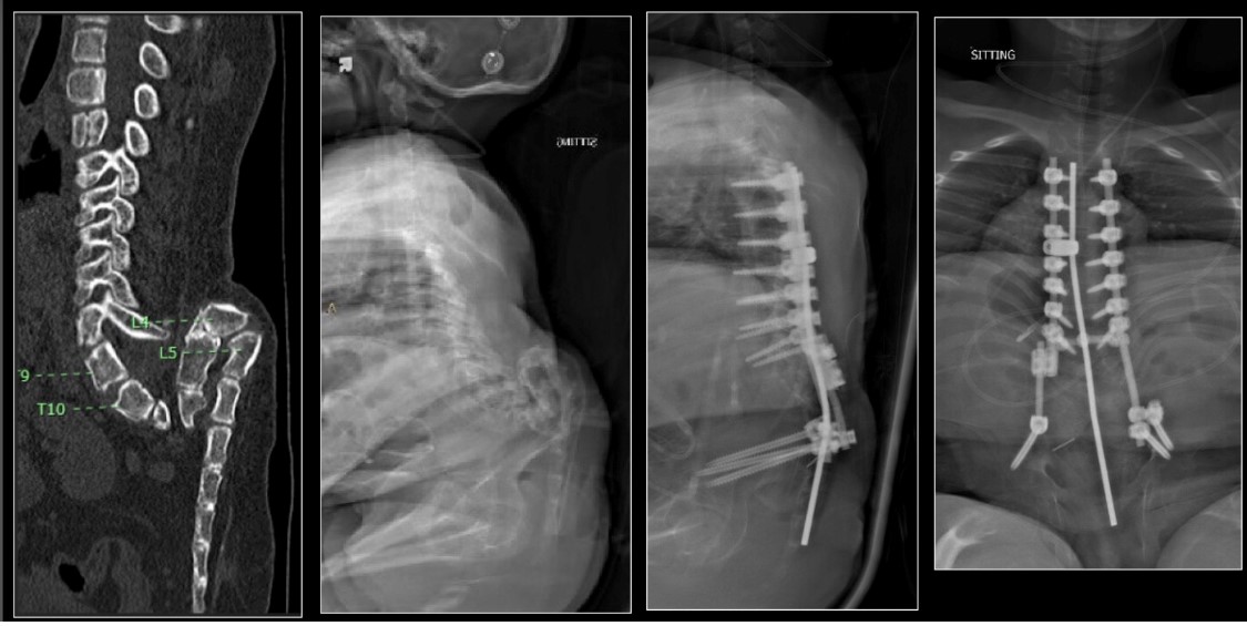 Thanks to a team of pediatric specialists @CedarsSinai, a young girl from the other side of the planet can eat & drink, live without a G-Tube, & sit up independently for the first time in 10 years following spine surgery #spinesurgery #spine #pediatrics #internationalhealth (1/2)