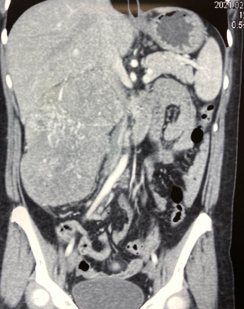 umaemac's tweet photo. Nefrectomía radical derecha en paciente de 54 años con diagnóstico de tumor de riñón T3b N0 M0 EC III #kidneycancer #urology https://t.co/r2z4SlOACQ
