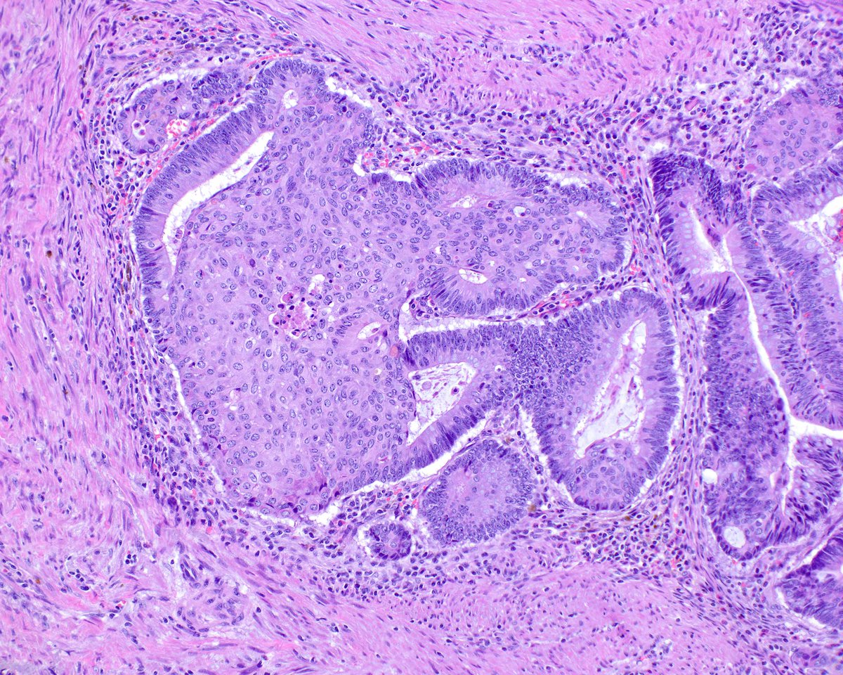 Squamous morules (some call them "microcarcinoids" because they can express neuroendocrine markers as well as squamous ones) in colorectal adenomas are fun to see.  This adenoma has lots of pseudo-invasion, so the nests are invested in their lamina propria.