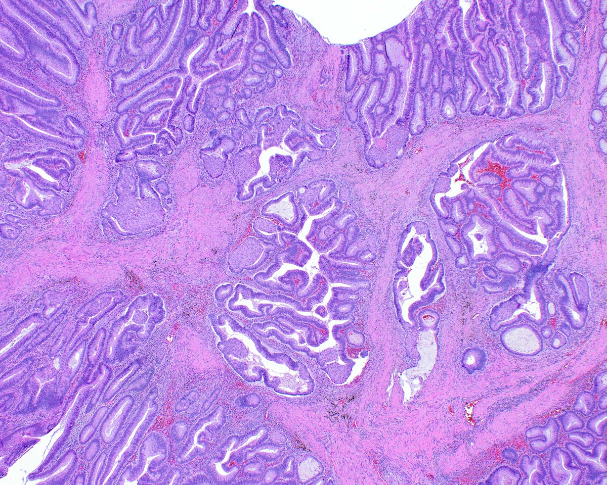 LizMontgomeryMD's tweet photo. Squamous morules (some call them "microcarcinoids" because they can express neuroendocrine markers as well as squamous ones) in colorectal adenomas are fun to see.  This adenoma has lots of pseudo-invasion, so the nests are invested in their lamina propria. https://t.co/565bKKCgWG