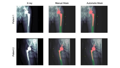 Radiology: Artificial Intelligence (@radiology_ai) on Twitter photo #DeepLearning tool measures subtle femoral component subsidence on AP hip radiographs doi.org/10.1148/ryai.2… <a href="/codywylesmd/">Cody Wyles</a> <a href="/radimpress/">Jason Cai</a> <a href="/slowvak/">Brad Erickson</a> #MSKrad #ML #MachineLearning #DeepLearning tool measures subtle femoral component subsidence on AP hip radiographs doi.org/10.1148/ryai.2… <a href="/codywylesmd/">Cody Wyles</a> <a href="/radimpress/">Jason Cai</a> <a href="/slowvak/">Brad Erickson</a> #MSKrad #ML #MachineLearning