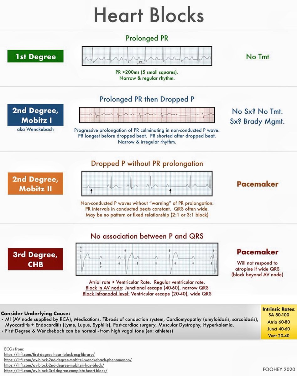 BrownJHM's tweet photo. Heart Blocks @SarahFoohey #BJHM #Heartblock #CHB #Cardiology #Cardiologia #Cardiotwitter #Medtwitter #FOAMed #MedEd #Mobitz #TipsForNewDocs #ECG https://t.co/uGB8oH84d9