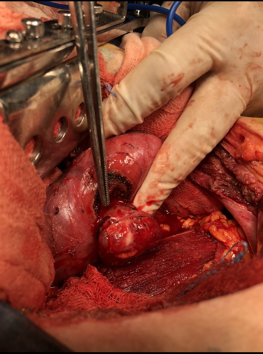 umaemac's tweet photo. Nefrectomía preservadora de nefronas en paciente de 57 años con diagnóstico de cáncer de riñón derecho T1b N0 M0 EC I #cancer #urology #kidney https://t.co/E9Nifik4IC