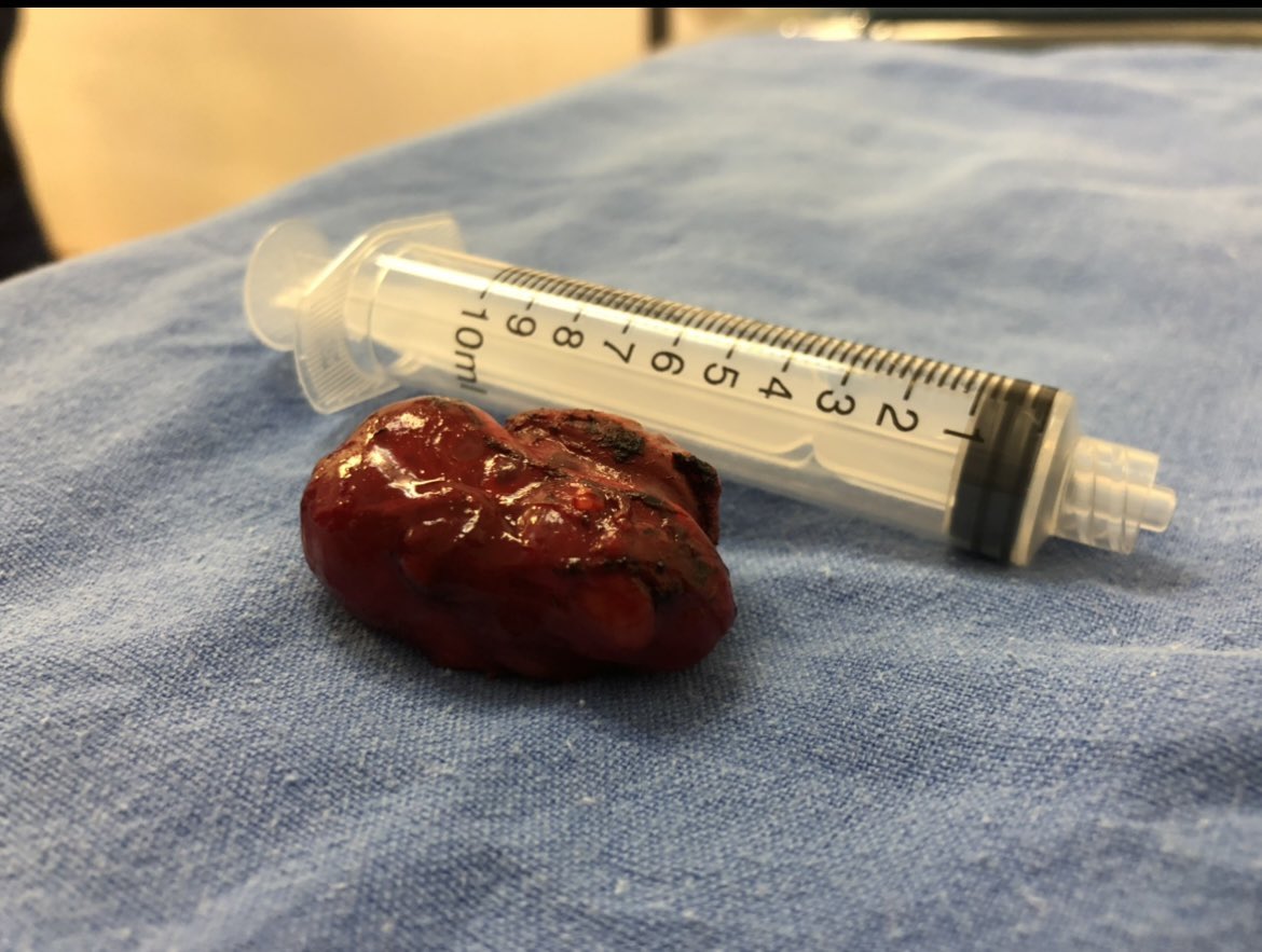 umaemac's tweet photo. Nefrectomía preservadora de nefronas en paciente de 57 años con diagnóstico de cáncer de riñón derecho T1b N0 M0 EC I #cancer #urology #kidney https://t.co/E9Nifik4IC