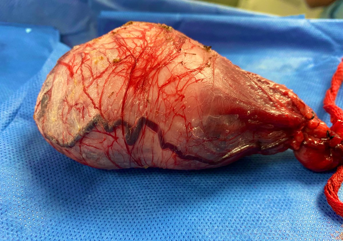 umaemac's tweet photo. Tumor de testículo Tx Nx Mx Sx en paciente de 22 años #oncology #urology #testicle #uro https://t.co/g2ryvXYbdC
