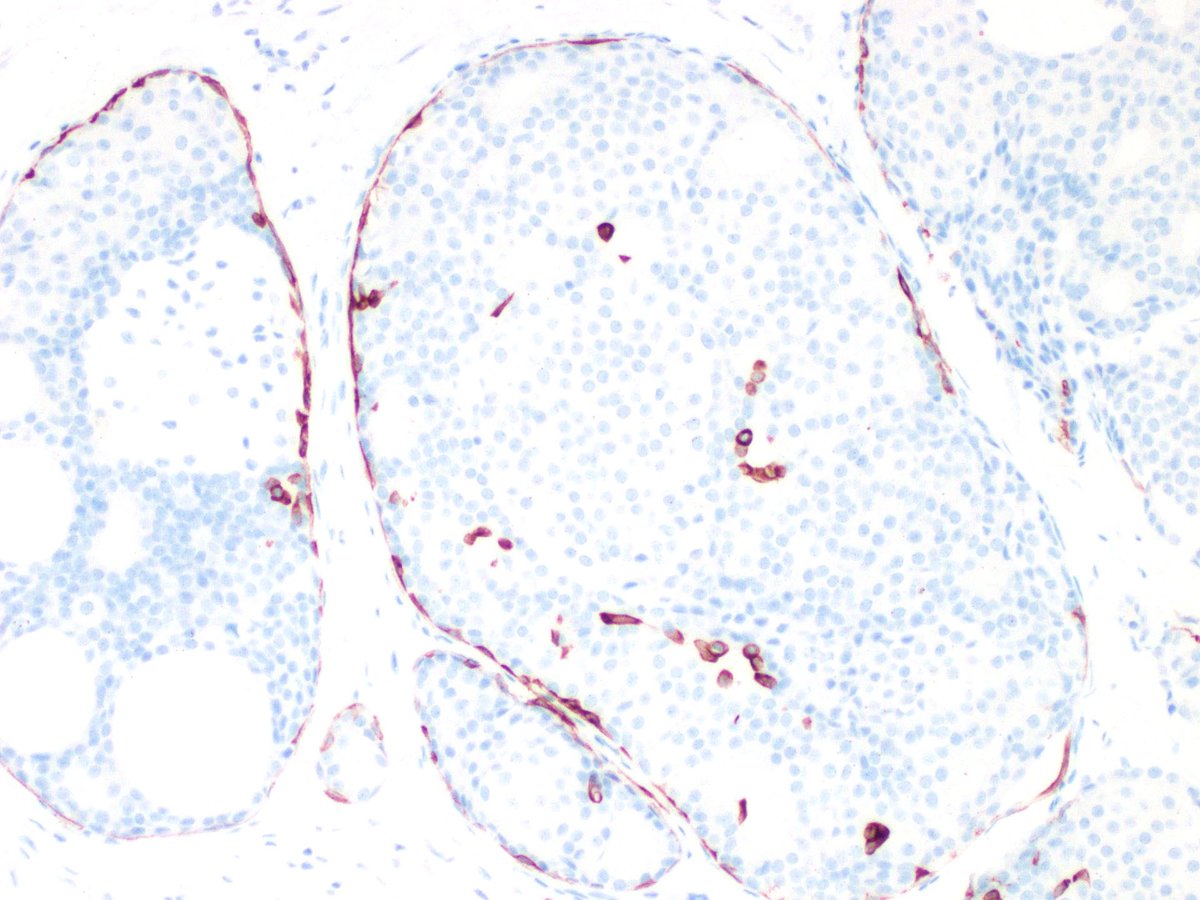 #BreastPath 

For breast path lovers - this will make you happy today 🥰🥰🥰🤩

Stains from left to right are E-cadherin and CK5/6