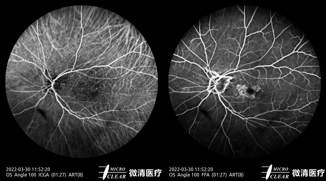 Microcleartec's tweet photo. AMD（1） #Agerelatedmaculardegeneration
Pictured by Apollo the #confocalretinalophthalmoscope
#octa #angiography #autofluorescence #icga #fluoresceinangiography #funduscamera #ophthalmology #ophthalmic https://t.co/YSdkfcc6Dn