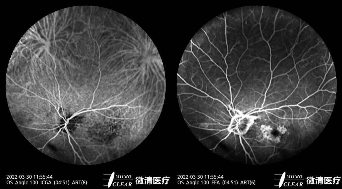 Microcleartec's tweet photo. AMD（2） #Agerelatedmaculardegeneration
Pictured by Apollo the #confocalretinalophthalmoscope
#octa #angiography #autofluorescence #icga #fluoresceinangiography #funduscamera #ophthalmology #ophthalmic https://t.co/W2dVgO2BtX