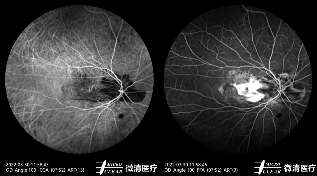 Microcleartec's tweet photo. AMD（2） #Agerelatedmaculardegeneration
Pictured by Apollo the #confocalretinalophthalmoscope
#octa #angiography #autofluorescence #icga #fluoresceinangiography #funduscamera #ophthalmology #ophthalmic https://t.co/W2dVgO2BtX