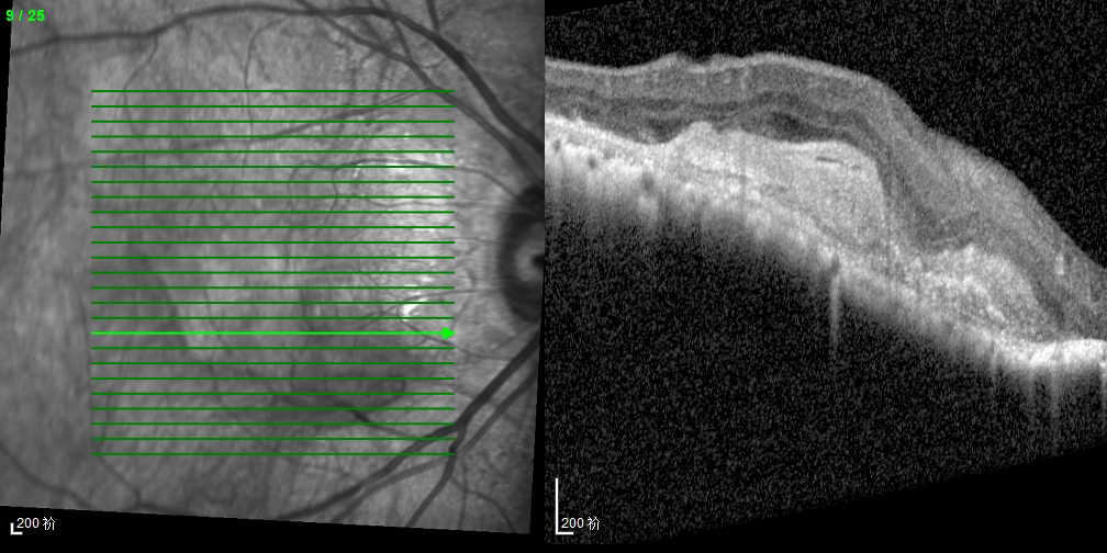 AMD（2） #Agerelatedmaculardegeneration
Pictured by Apollo the #confocalretinalophthalmoscope
#octa #angiography #autofluorescence #icga #fluoresceinangiography #funduscamera #ophthalmology #ophthalmic
