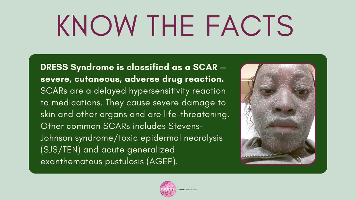 DRESS Syndrome is classified as a SCARsevere, cutaneous, adverse drug reaction. They cause severe damage to skin & other organs, & are life-threatening. DRESS keeps company w/ Stevens-Johnson/toxic epidermal necrolysis & acute DRESS Syndrome is classified as a SCARsevere, cutaneous, adverse drug reaction. They cause severe damage to skin & other organs, & are life-threatening. DRESS keeps company w/ Stevens-Johnson/toxic epidermal necrolysis & acute