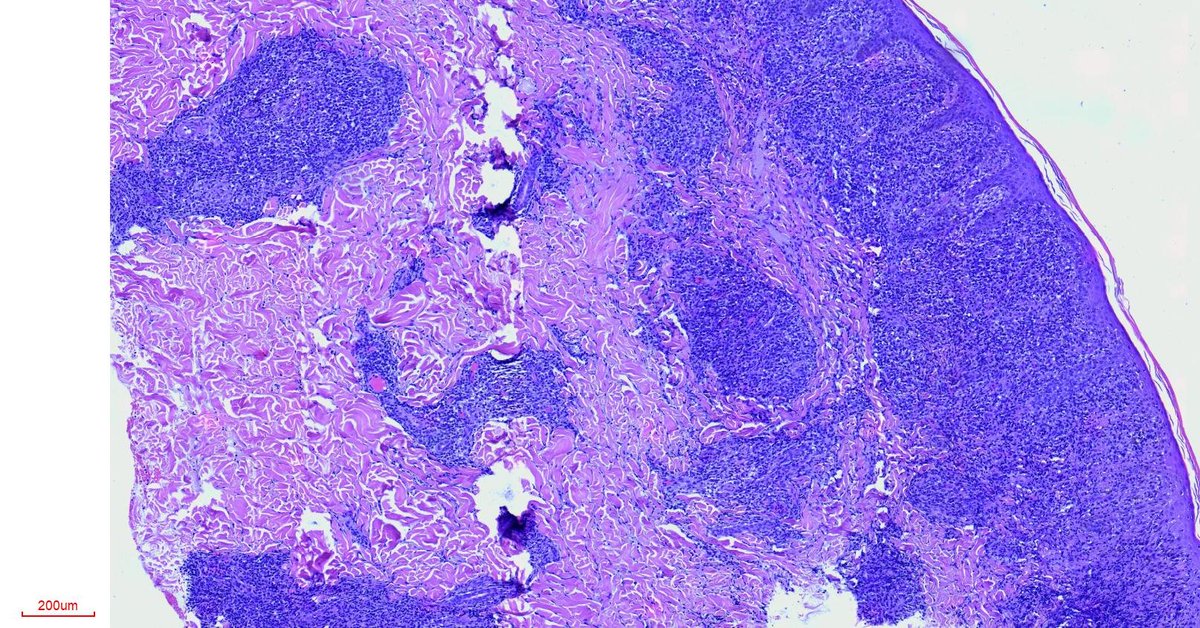 PathoPictures's tweet photo. 22 yr old male, spot IHC diagnosis (acanthosis with pseudolymphomatous infiltrate, + plasmacytes++) https://t.co/pLsBYU6Ikv