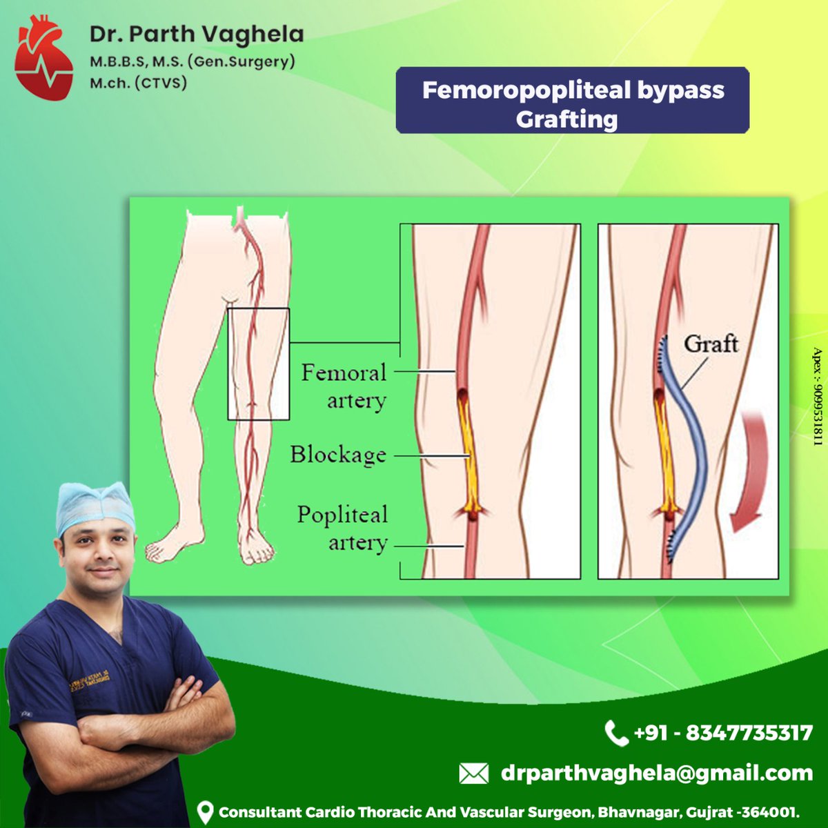 FEMOROPOPLITEAL BYPASS GRAFTING

#femoropoplitealbypass #graft #femoralartery #blockage #poplitealartery  #drparthvaghela #doctor #hospital #endovenouslasertreatment #CTVS #cardiothoracicsurgery #vascularsurgery #bhavnagar #Gujarat #india