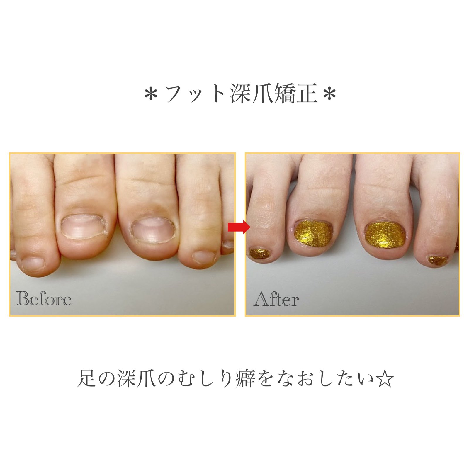 深爪矯正サロン ハンドとフット爪の長さだし 下北沢自爪育成ネイルサロン Nailsalonallume Twitter