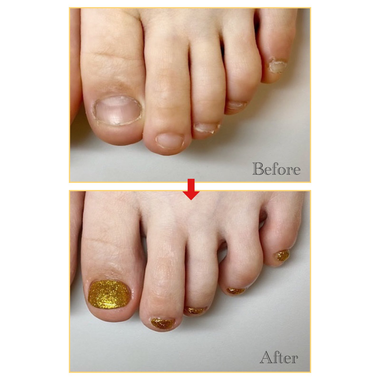 深爪矯正サロン ハンドとフット爪の長さだし 下北沢自爪育成ネイルサロン Nailsalonallume Twitter