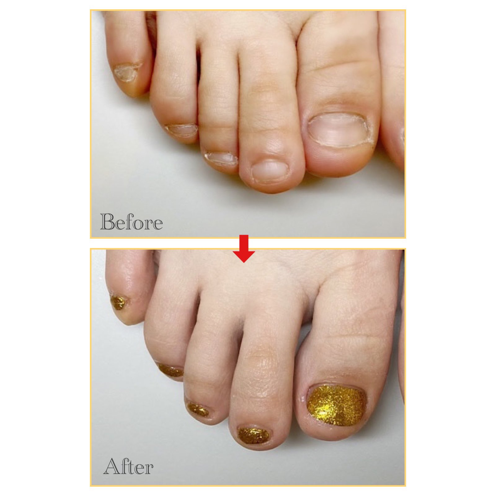 深爪矯正サロン ハンドとフット爪の長さだし 下北沢自爪育成ネイルサロン Nailsalonallume Twitter