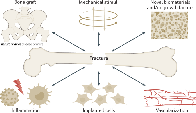 DiseasePrimers's tweet image. Adequate mechanical load, #inflammation and #vascularization are a mandatory part of #nonunion bone fracture management whereas bone graft, biomaterials and cell application are optional.

go.nature.com/3jrGxHc