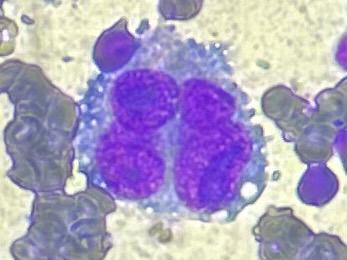 Savitri Singh (@savitri93718607) on Twitter photo All matted lymph nodes are not tuberculosis. FNAC of a 6-year-old boy with fever, lymphadenopathy and already on Anti-tubercular treatment @ssphpgti <a href="/iapindia/">Indian Academy of Pediatrics (IAP)</a> #hemepath All matted lymph nodes are not tuberculosis. FNAC of a 6-year-old boy with fever, lymphadenopathy and already on Anti-tubercular treatment @ssphpgti <a href="/iapindia/">Indian Academy of Pediatrics (IAP)</a> #hemepath