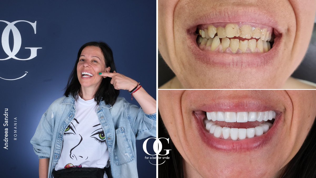 dtozanguner's tweet photo. Andreea Sandru visited us from the Romania. We made 4 dental implants and 28 zirconium crowns for her. Keep smiling Andreeea!
๐+491783233900
#ogsmile #dentist #dentalclinic #dentistry #ozanguner #dentalimplants #zirconiumcrowns https://t.co/qminakB84W