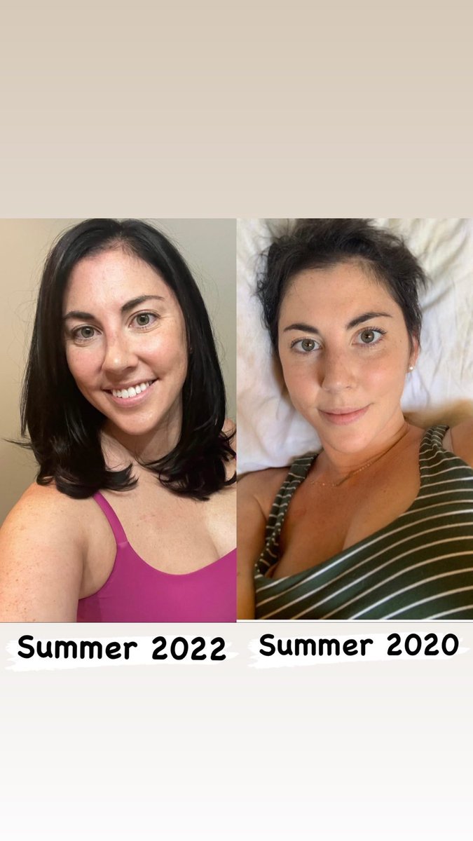 AlexaMorell4's tweet photo. 26 months off of #Folfoxiri ! I can’t believe how much my hair has grown since then! 🥹💕💙🙏 #cancerlikeamama #youngonsetcrc #fcancer #colorectalcancer #NED @DFarberYoungCRC #stage4crc #hairgrowth @DanaFarber https://t.co/1S4flpq3KQ