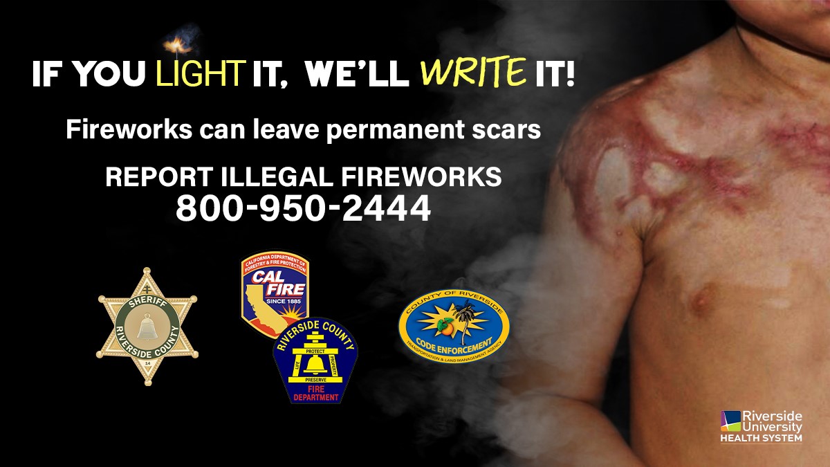 RUHSPH's tweet photo. Mishandling  #fireworks can lead to serious bodily injury. Leave the fireworks to the professionals! #RivCo #RiversideCounty #FireworksAreIllegal #IfYouLightIt #WeWriteIt #Fireworks #IllegalFireworks https://t.co/3ec7sec6eg