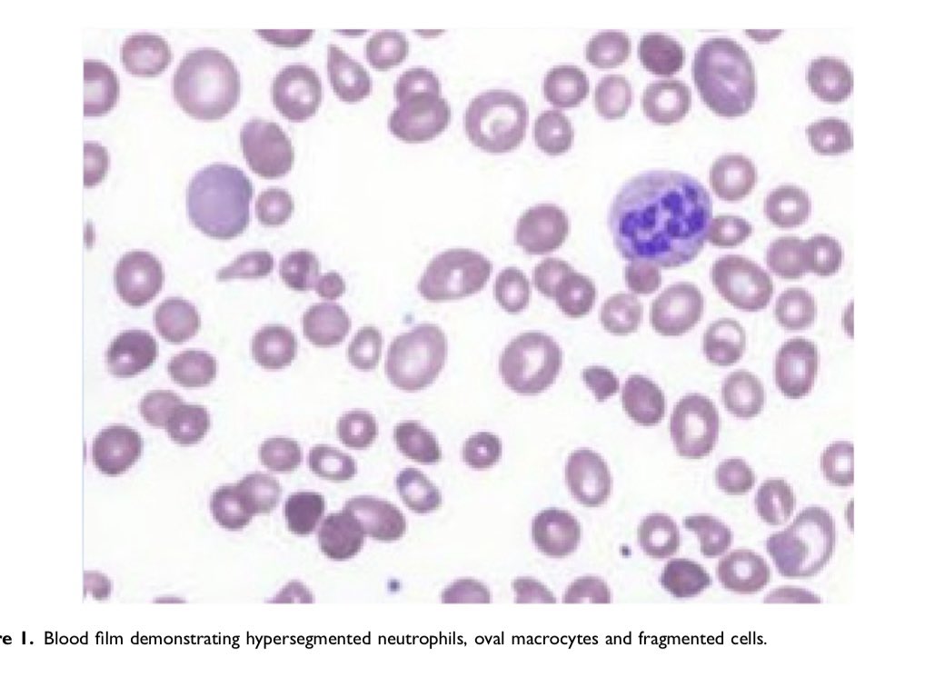OBMedicine's tweet image. New online!
“Haematinic deficiency in pregnancy: another HELLP mimic”
by @drlaurengreen @obstetricmedic et al

journals.sagepub.com/doi/full/10.11…