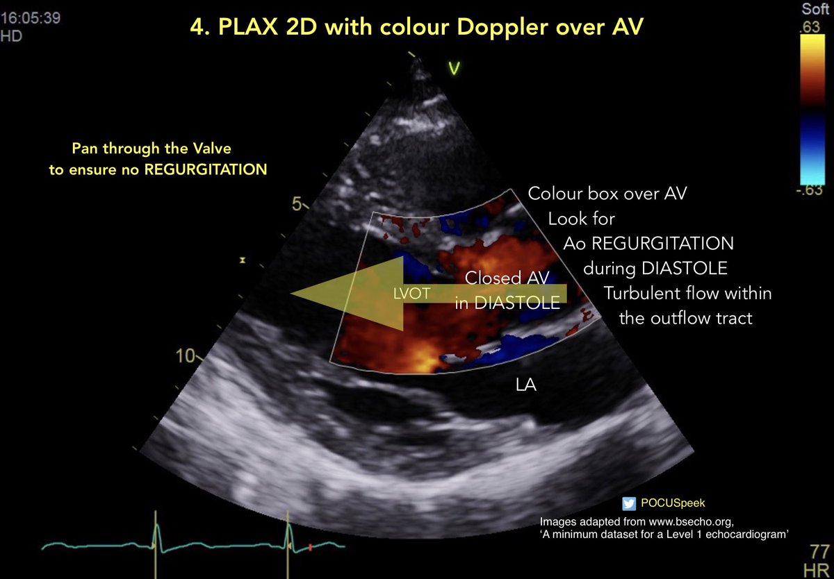 POCUSpeek's tweet image. Aortic Regurgitation and Mitral Regurgitation Jet Direction 👇🏻 Jet Direction in PLAX 2D with Colour Doppler for #firstecho @pocusmeded @POCUS_Society @pocusfoamed @PracticalPOCUS @The_echo_lady @echocardiac