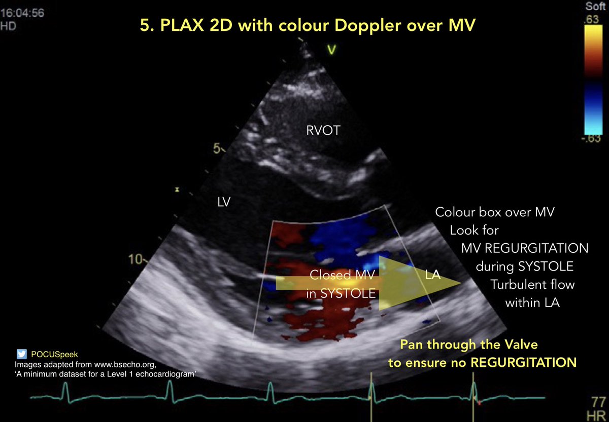 POCUSpeek's tweet image. Aortic Regurgitation and Mitral Regurgitation Jet Direction 👇🏻 Jet Direction in PLAX 2D with Colour Doppler for #firstecho @pocusmeded @POCUS_Society @pocusfoamed @PracticalPOCUS @The_echo_lady @echocardiac