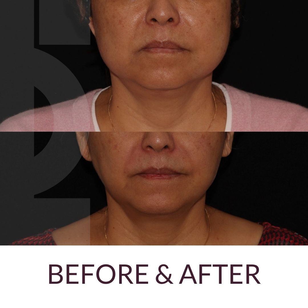 ⁣💫 Endolift Transformation 💫⁣

Check out endolift on the PHI Clinic website: ow.ly/S2Uw50JkJYw
