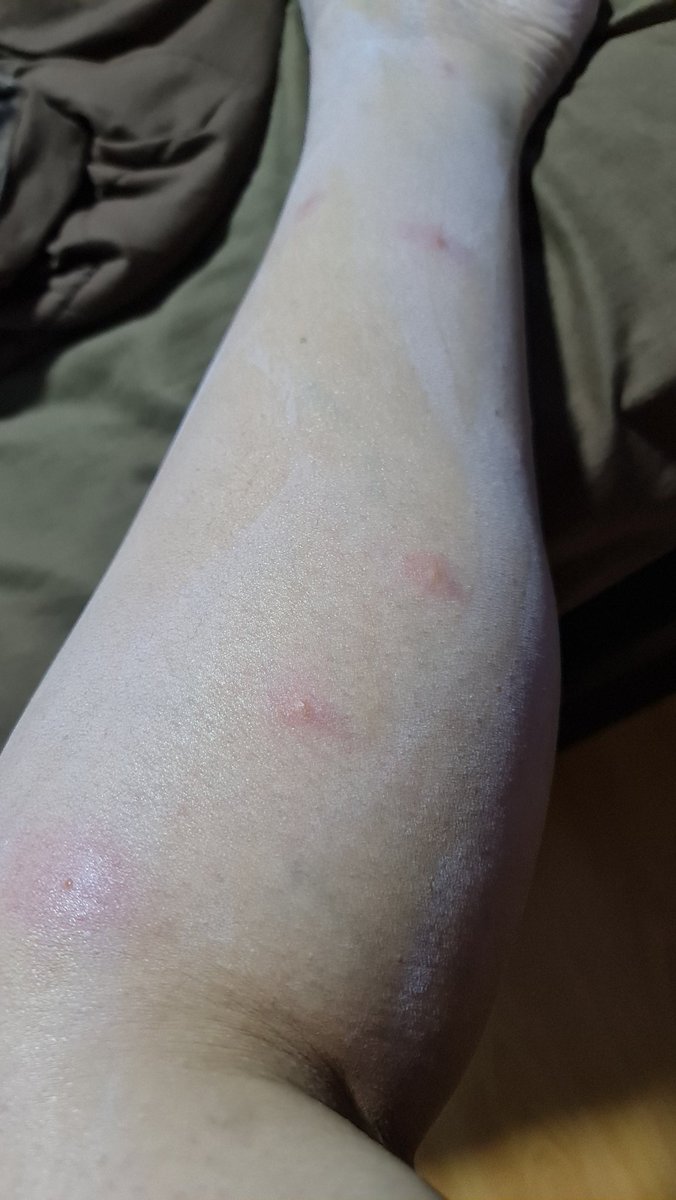 palmerdebra's tweet photo. The price I pay for having such a great day at the beach. Sand flea bites! ππ #sandflea #bites https://t.co/jhu5kVt9nW