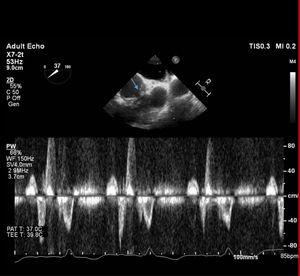 REC Publications (@revespcardiol) on Twitter photo An unusual case of Brucella endocarditis involving a prosthetic pulmonary valve #REC #Cardiotwitter
<a href="/RamiGeorgeMaal1/">Rami George Maalouf</a> <a href="/darinedaher/">Darine Daher</a> <a href="/AbdallahRebeiz/">Abdallah Rebeiz</a> <a href="/kanaf001/">Zeina Kanafani</a> revespcardiol.org//en-an-unusual⦠An unusual case of Brucella endocarditis involving a prosthetic pulmonary valve #REC #Cardiotwitter
<a href="/RamiGeorgeMaal1/">Rami George Maalouf</a> <a href="/darinedaher/">Darine Daher</a> <a href="/AbdallahRebeiz/">Abdallah Rebeiz</a> <a href="/kanaf001/">Zeina Kanafani</a> revespcardiol.org//en-an-unusualā¦