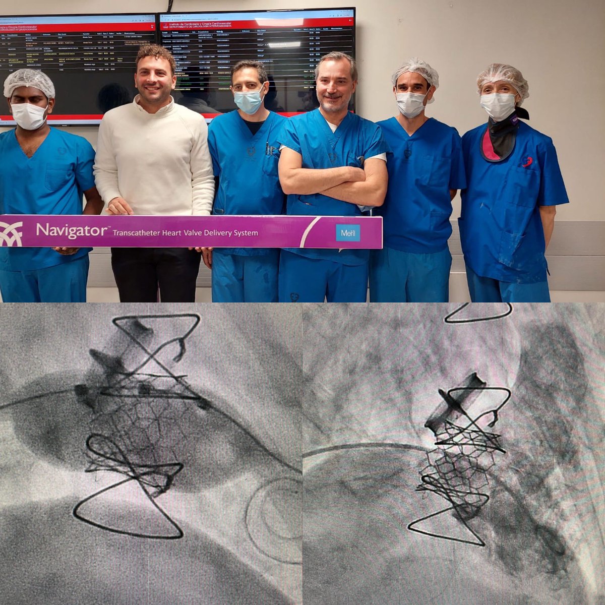 omendiz's tweet photo. #TTVR for #ViV with #MyValve with @lamelaspablo and @CarlosFava4 https://t.co/86mD0aX1bM