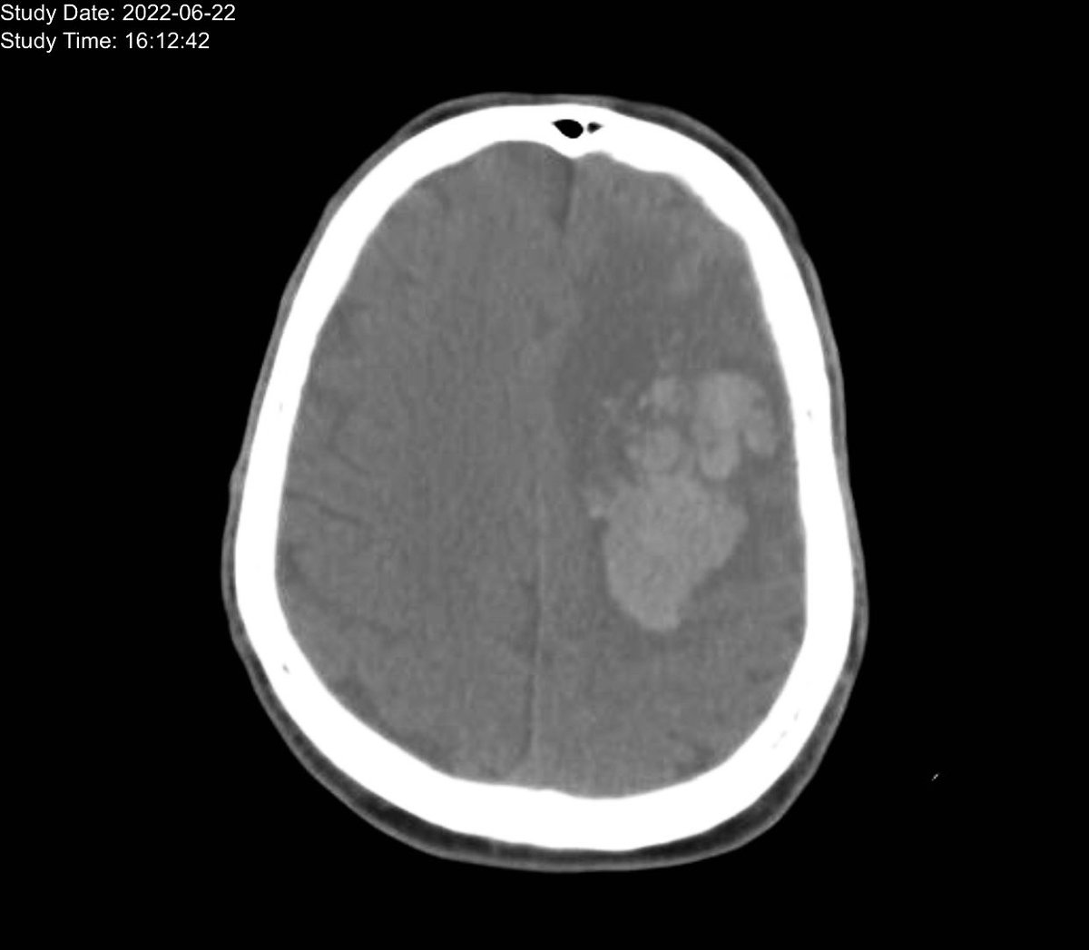 DannySilvaC1's tweet photo. 71 años app HTA DM,hemiparesia,afasia,hemorragia intraencefalica,coMpromiso ACM.
Causa Angiopatia amiloide cerebral. Mal pronostico 20 al 90% mortalidad https://t.co/RTgrP5VEIS